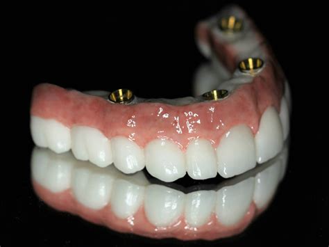 Full mouth dental implants homewood north pa